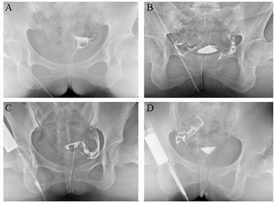 Comparison of Hysterosalpingography With Laparoscopy in the Diagnosis of Tubal Factor of Female Infertility